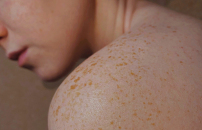 Maggio, il mese della prevenzione del melanoma