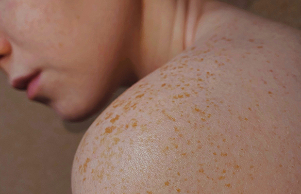 Maggio, il mese della prevenzione del melanoma
